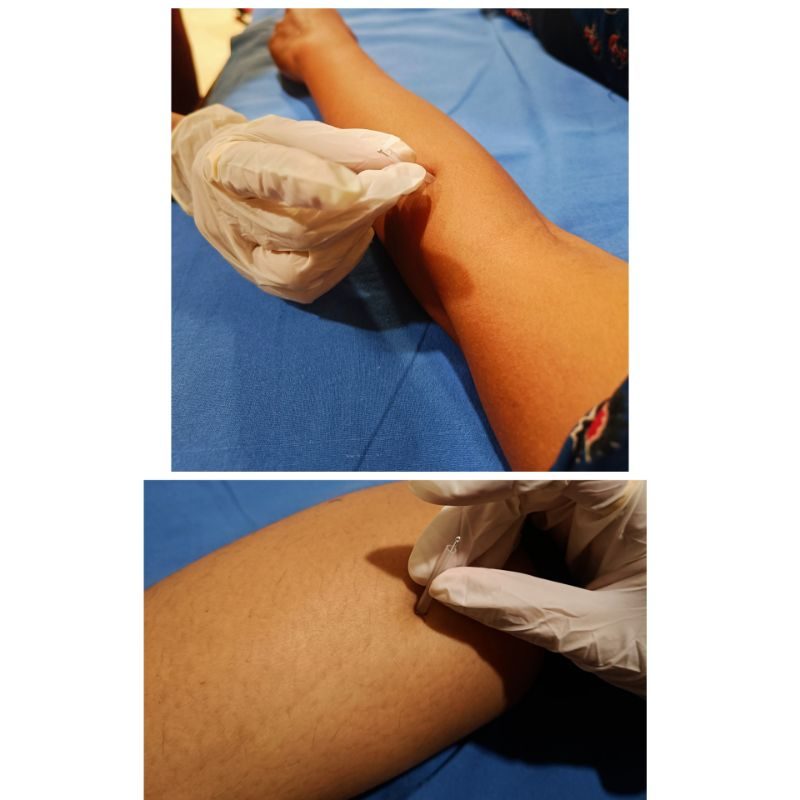 Dry Needling at Faith Physical Therapy, Thane